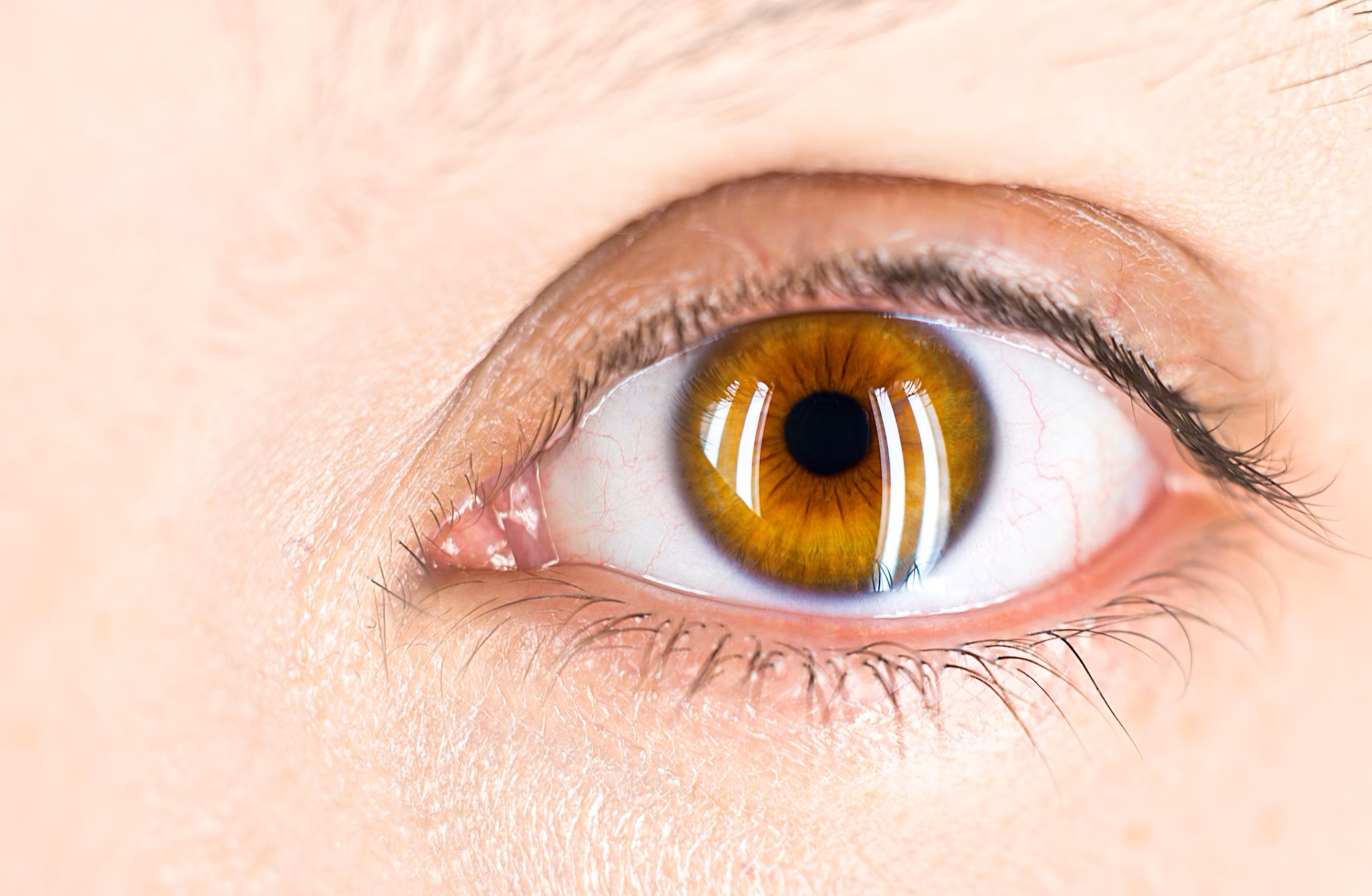 Wat is een strontje in je oog?