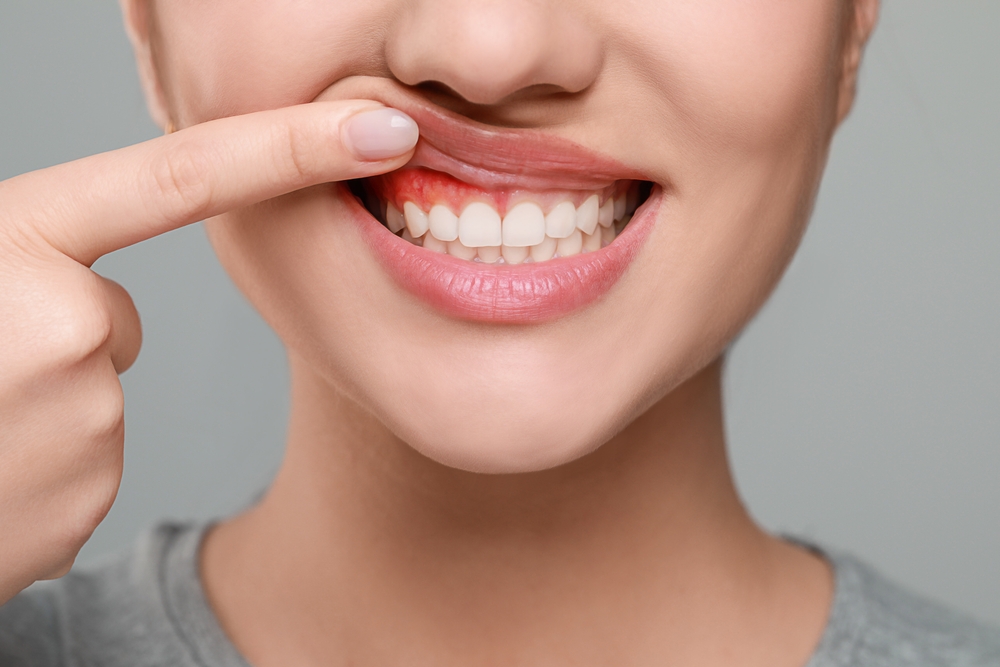 Zwaar ontstoken tandvlees herkennen en tips voor behandeling – Leef.nl