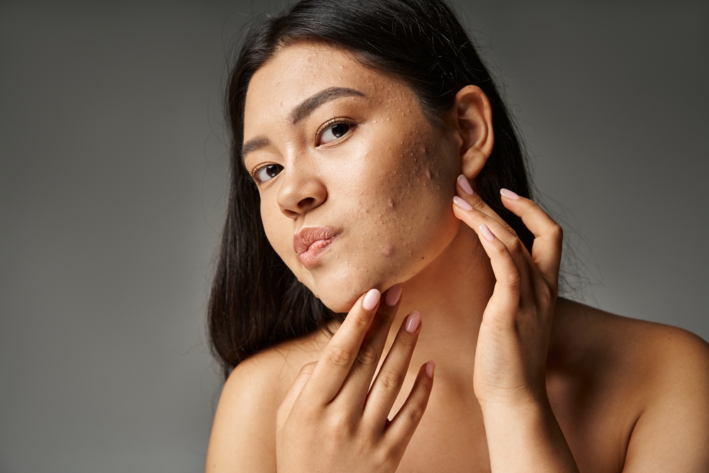 Gezicht met hormonale acne; informatie over oorzaken en behandelingen voor een gezonde huid.