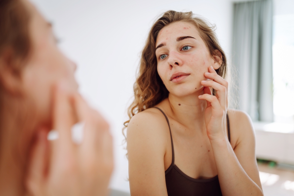 Acne voorkomen met huidverzorging en tips van Leef.nl