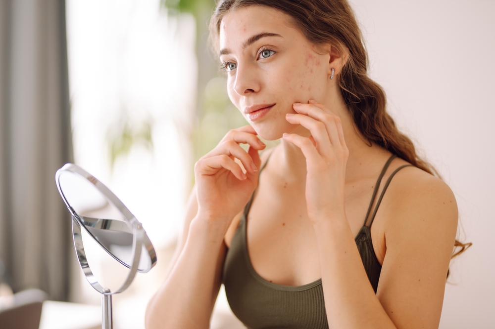 Gezichtsverzorging en behandelingen om acne littekens te verminderen, zoals crèmes, lasertherapie en microneedling.