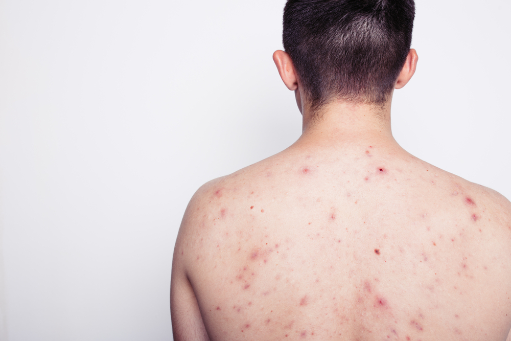 Acne op de rug: oorzaken en verzorgingstips voor een gezonde huid.